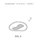 SYSTEMS AND METHODS FOR DELIVERY OF A THERAPEUTIC AGENT diagram and image