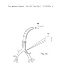 SYSTEMS AND METHODS FOR DELIVERY OF A THERAPEUTIC AGENT diagram and image