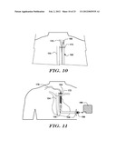 Subcutaneous Leads and Methods of Implant and Explant diagram and image