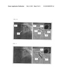 ACCOUNTING FOR FORWARD MOTION DURING PULLBACK OF AN ENDOLUMINAL IMAGING     PROBE diagram and image