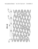 FLEXIBLE HELICAL STENT HAVING INTERMEDIATE NON-HELICAL REGION diagram and image