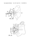 Shoulder Implant Assemby diagram and image