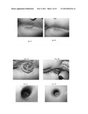 PHARMACEUTICAL COMPOSITIONS FOR DEHYDRATING, ATROPHYING AND ELIMINATING     PATHOLOGICAL TISSUES diagram and image