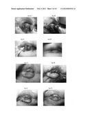 PHARMACEUTICAL COMPOSITIONS FOR DEHYDRATING, ATROPHYING AND ELIMINATING     PATHOLOGICAL TISSUES diagram and image