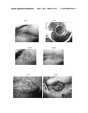 PHARMACEUTICAL COMPOSITIONS FOR DEHYDRATING, ATROPHYING AND ELIMINATING     PATHOLOGICAL TISSUES diagram and image