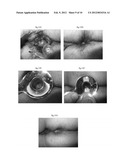 PHARMACEUTICAL COMPOSITIONS FOR DEHYDRATING, ATROPHYING AND ELIMINATING     PATHOLOGICAL TISSUES diagram and image