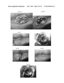 PHARMACEUTICAL COMPOSITIONS FOR DEHYDRATING, ATROPHYING AND ELIMINATING     PATHOLOGICAL TISSUES diagram and image