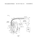 RHYTHM DISCRIMINATION ENHANCEMENT - CHAMBER OF TACHY ORIGINATION diagram and image