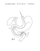 DELIVERY SYSTEM FOR MAGNETIC ANASTOMOSIS DEVICE diagram and image