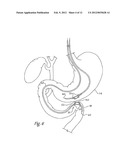 DELIVERY SYSTEM FOR MAGNETIC ANASTOMOSIS DEVICE diagram and image