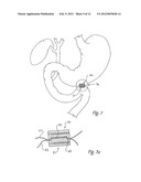 DELIVERY SYSTEM FOR MAGNETIC ANASTOMOSIS DEVICE diagram and image