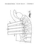 Dynamic stabilization medical implant assemblies and methods diagram and image