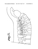 Dynamic stabilization medical implant assemblies and methods diagram and image