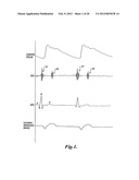 PULSE DETECTION APPARATUS, SOFTWARE, AND METHODS USING PATIENT     PHYSIOLOGICAL SIGNALS diagram and image