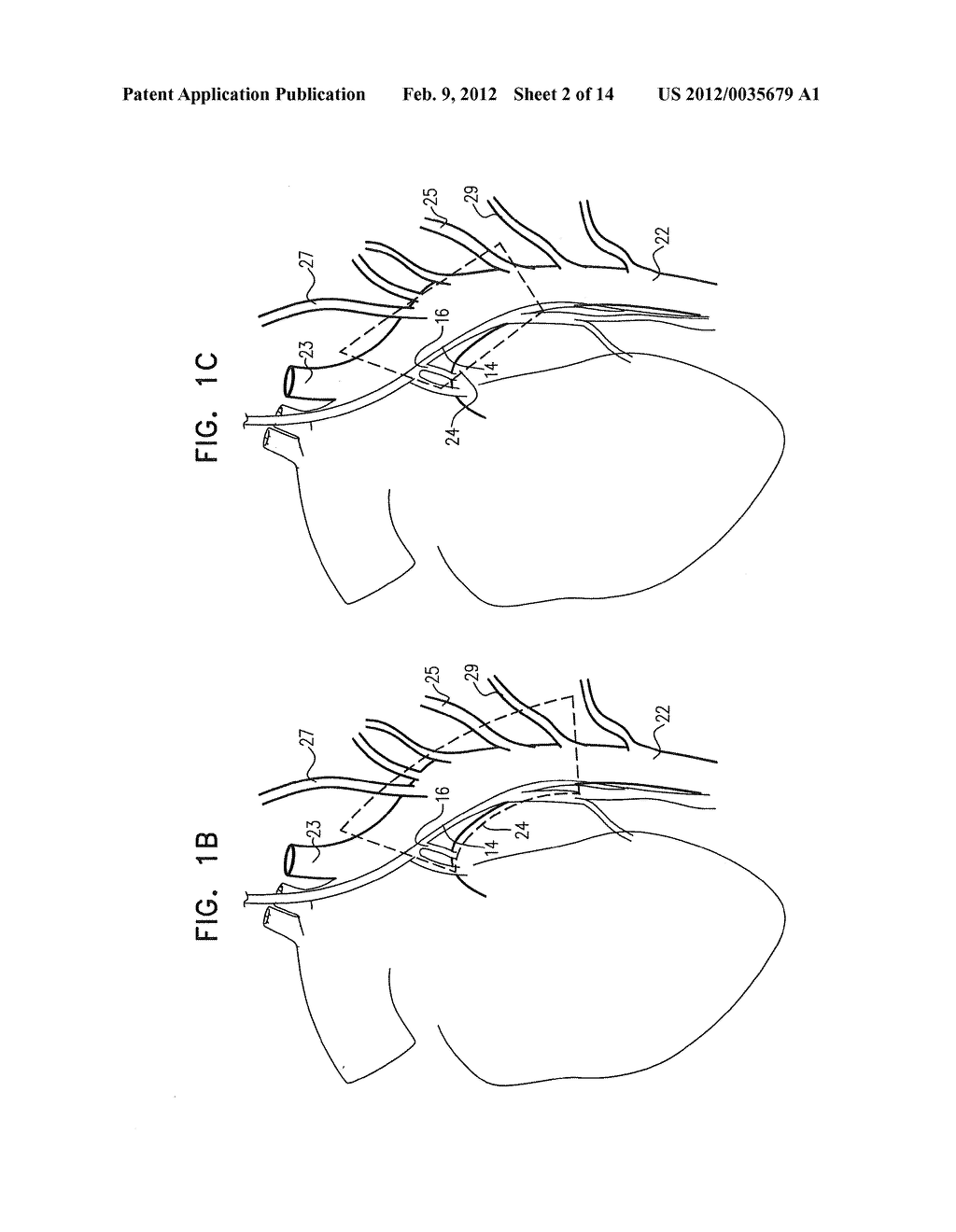 ACUTE MYOCARDIAL INFARCTION TREATMENT BY ELECTRICAL STIMULATION OF THE     THORACIC AORTA - diagram, schematic, and image 03