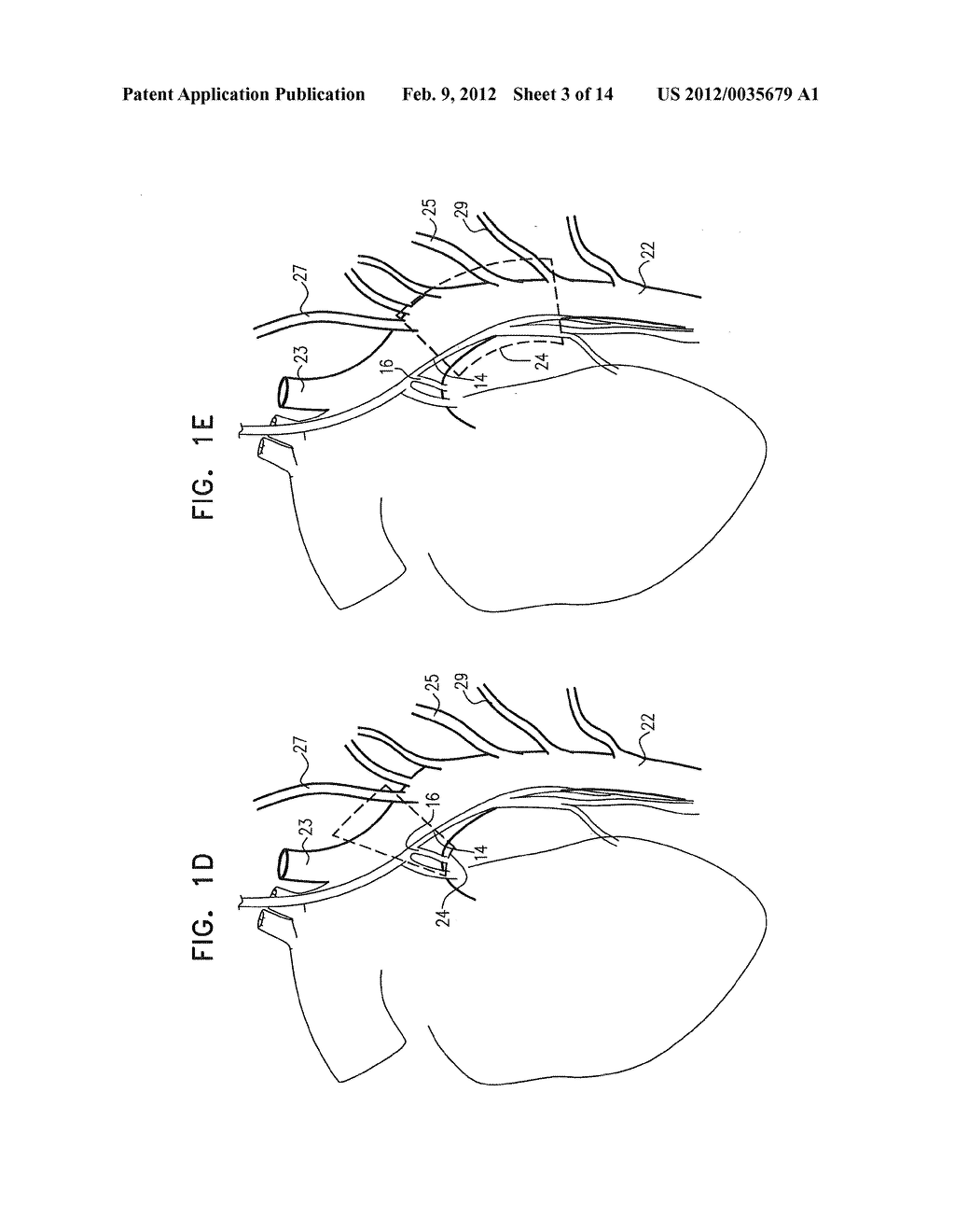 ACUTE MYOCARDIAL INFARCTION TREATMENT BY ELECTRICAL STIMULATION OF THE     THORACIC AORTA - diagram, schematic, and image 04