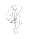 ACUTE MYOCARDIAL INFARCTION TREATMENT BY ELECTRICAL STIMULATION OF THE     THORACIC AORTA diagram and image