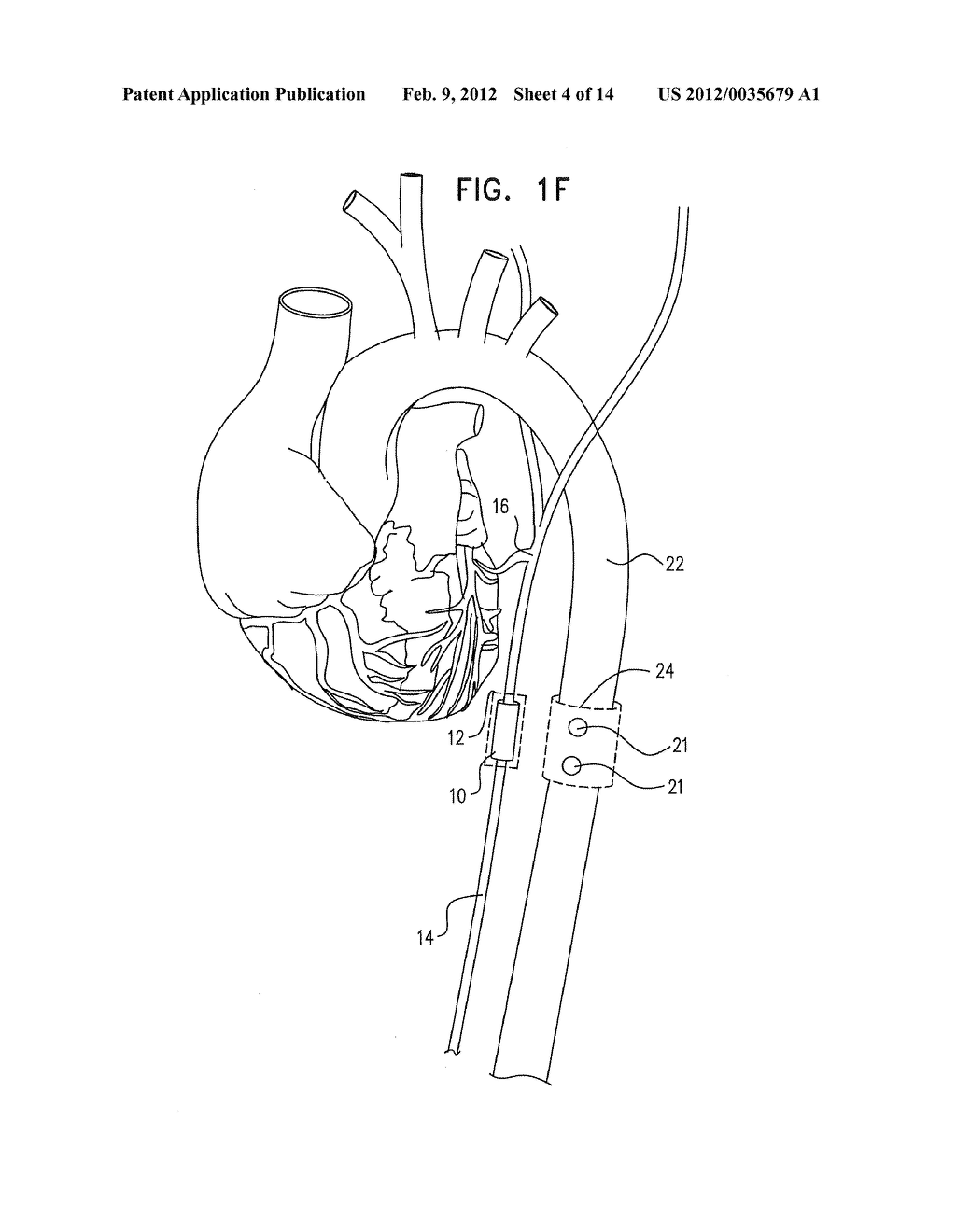 ACUTE MYOCARDIAL INFARCTION TREATMENT BY ELECTRICAL STIMULATION OF THE     THORACIC AORTA - diagram, schematic, and image 05