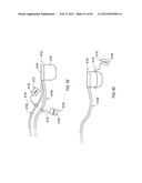 TERMINATION OF A SHIELD WITHIN AN IMPLANTABLE MEDICAL LEAD diagram and image