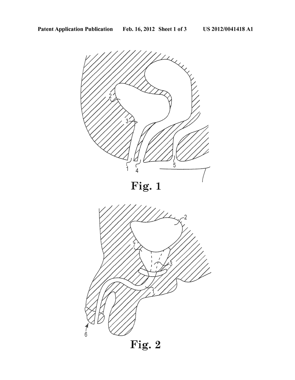 BIOLOGIC TREATMENT SYSTEM AND METHOD - diagram, schematic, and image 02