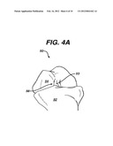 TUNNEL NOTCHER AND GUIDEWIRE DELIVERY DEVICE diagram and image