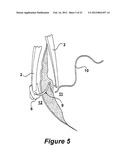 SURGICAL INSTRUMENT AND METHOD diagram and image