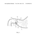 DEVICES AND METHODS FOR TREATING GASTROINTESTINAL AND METABOLIC DISORDERS diagram and image