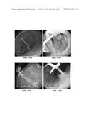 DEVICES AND METHODS FOR TREATING GASTROINTESTINAL AND METABOLIC DISORDERS diagram and image