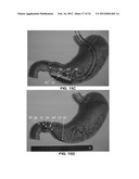 DEVICES AND METHODS FOR TREATING GASTROINTESTINAL AND METABOLIC DISORDERS diagram and image