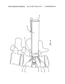 VERTEBRAL IMPLANT diagram and image