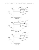 TERMINATION OF A SHIELD WITHIN AN IMPLANTABLE MEDICAL LEAD diagram and image