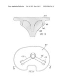 ORTHOPAEDIC IMPLANTS AND METHODS diagram and image