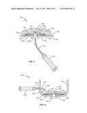 ANCHORING IMPLANT diagram and image