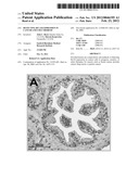 DETECTING BCL-B EXPRESSION IN CANCER AND USES THEREOF diagram and image