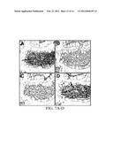 DETECTING BCL-B EXPRESSION IN CANCER AND USES THEREOF diagram and image