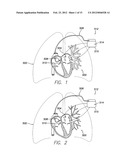 SYSTEM AND METHOD FOR DETECTING AND TREATING CARDIOVASCULAR DISEASE diagram and image