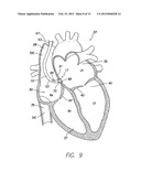 SYSTEM AND METHOD FOR DETECTING AND TREATING CARDIOVASCULAR DISEASE diagram and image