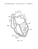 METHODS AND SYSTEMS TO MONITOR AND IDENTIFY TRANSIENT ISCHEMIA diagram and image