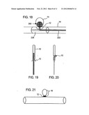 Aneurysm Flow Barrier diagram and image