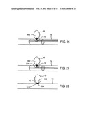 Aneurysm Flow Barrier diagram and image