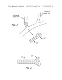 METHOD OF DELIVERING A MEDICAL DEVICE ACROSS A VALVE diagram and image