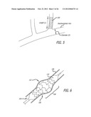 METHOD OF DELIVERING A MEDICAL DEVICE ACROSS A VALVE diagram and image