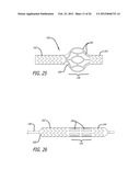 METHOD OF DELIVERING A MEDICAL DEVICE ACROSS A VALVE diagram and image