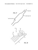 METHOD OF DELIVERING A MEDICAL DEVICE ACROSS A VALVE diagram and image