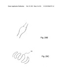 METHOD OF DELIVERING A MEDICAL DEVICE ACROSS A VALVE diagram and image