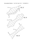 METHOD OF DELIVERING A MEDICAL DEVICE ACROSS A VALVE diagram and image