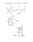 METHOD OF DELIVERING A MEDICAL DEVICE ACROSS A VALVE diagram and image