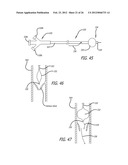 METHOD OF DELIVERING A MEDICAL DEVICE ACROSS A VALVE diagram and image