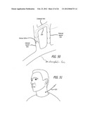 METHOD OF DELIVERING A MEDICAL DEVICE ACROSS A VALVE diagram and image