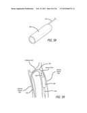 METHOD OF DELIVERING A MEDICAL DEVICE ACROSS A VALVE diagram and image